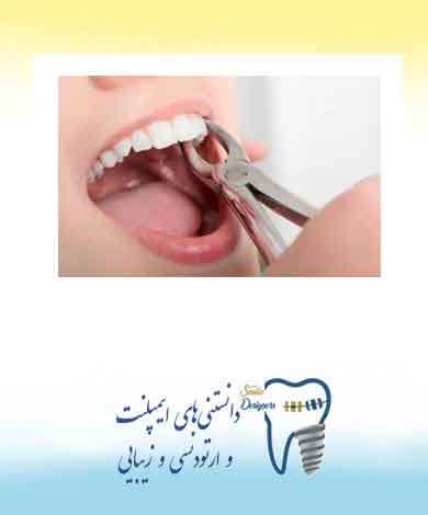 کشیدن یا نکشیدن دندان در ارتودنسی