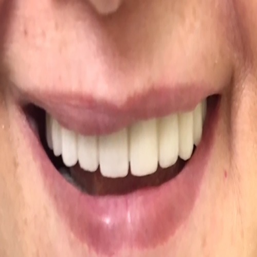 باز سازی هر دو فک بی دندان با ایمپلنت