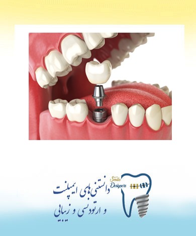 ایمپلنت (کاشت دندان) با استفاده از تکنولوژی دیجیتال توسط متخصص ایمپلنت