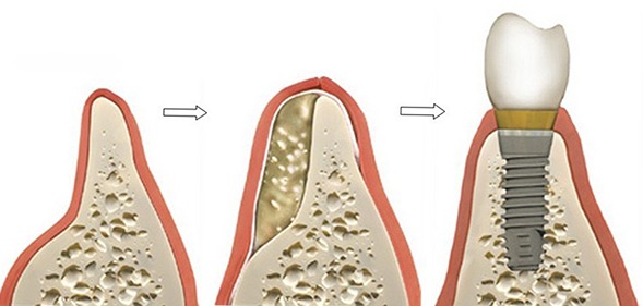 ایمپلنت نوعی پروتز مصنوعی جایگزین دندان از دست رفته است. پایه ایمپلنت در استخوان فک کاشته می‌شود تا روکش دندان که جایگزین تاج میشود را پشتیبانی کرده و محکم نگه دارد.بهتر است توسط دندانپزشک متخصص   ایمپلنت  دندان خوب در تهران انجام شود.