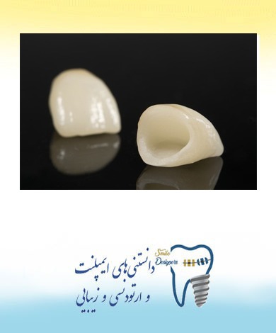 روکش دندان تمام سرامیک  توسط متخصص پروتز دندان و ایمپلنت و زیبایی در شمال تهران