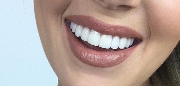 ونیر کامپوزیت نوعی ترمیم زیبایی است که برای بهبود رنگ، شکل، اندازه، بافت و اصلاح نقایص دندانی  مورد استفاده قرار می‌گیرد.بهتر است توسط دندانپزشک متخصص   زیبایی دندان انجام شود.