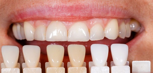 ونیر پرسلن که به آن ونیر سرامیکی یا چینی نیز گفته می‌شود، پوسته ای نازک از جنس پرسلن و همرنگ دندان است که همانند ناخن مصنوعی بر روی سطح جلوئی دندان‌ها چسبانده می‌شود.بهتر است توسط دندانپزشک متخصص پروتزهای دندانی و  ایمپلنت   انجام شود.