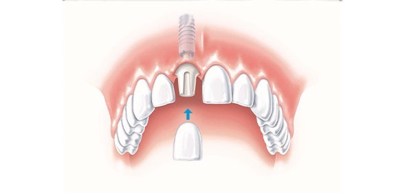 تکنیک جایگذاری بدون جراحی (بدون برش لثه ) ایمپلنت دندان  جهت حفظ ساختار لثه و استخوان فک و جلوگیری  از تحلیل بیشتر لثه و استخوان به کار می رود . و بهتر است توسط دندانپزشک متخصص ایمپلنت درمان شود.