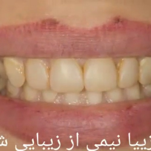 تعویض کامپوزیت های رنگ گرفته دندانهای بالا با لامینیت های سرامیکی توسط بهترین متخصص پروتزهای دندانی و زیبایی در تهران