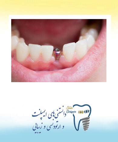 کاشت ایمپلنت دندان  فوری توسط متخصص ایمپلنت در تهران