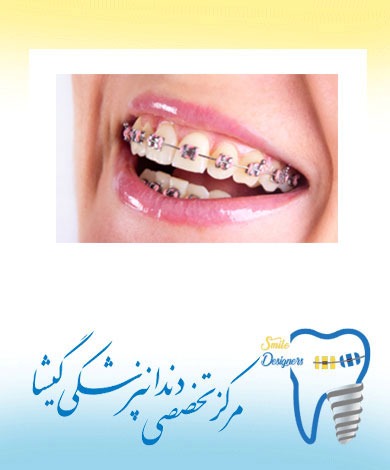 درمان ارتودنسی دندان نهفته  توسط متخصص  ارتودنسی