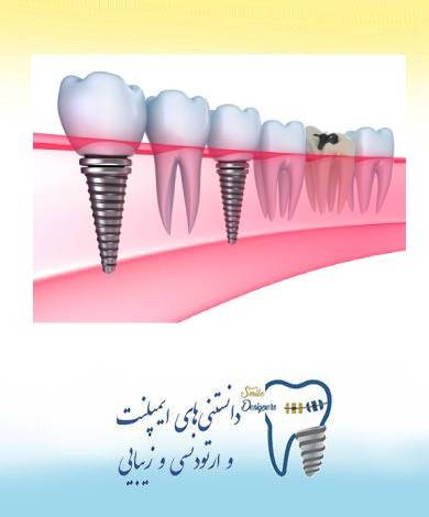 زراعة الأسنان الفورية من قبل أفضل أخصائي زراعة الأسنان في طهران