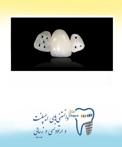 بریج مریلند توسط متخصص پروتز های دندانی و ایمپلنت در تهران