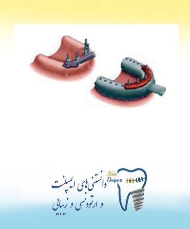 روشهای  قالب گیری ایمپلنت توسط متخصص پروتزهای دندانی و ایمپلنت  در تهران