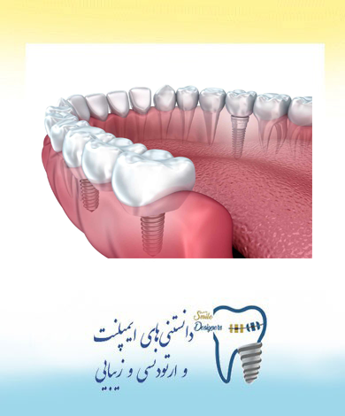Who is the best dental implant specialist in Tehran?