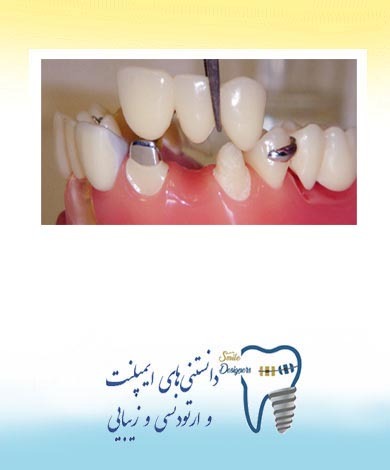 تفاوت ایمپلنت و دندان طبیعی