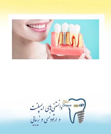 چرا باید ایمپلنت دندان بکاریم؟