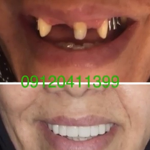 بازسازی دندانها با ایمپلنت و روکش در کلینیک گیشا